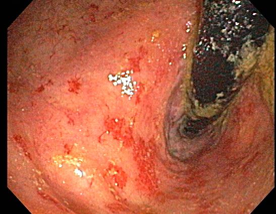 <p>Moderate-to-Severe Radiation Proctitis on Colonoscopy