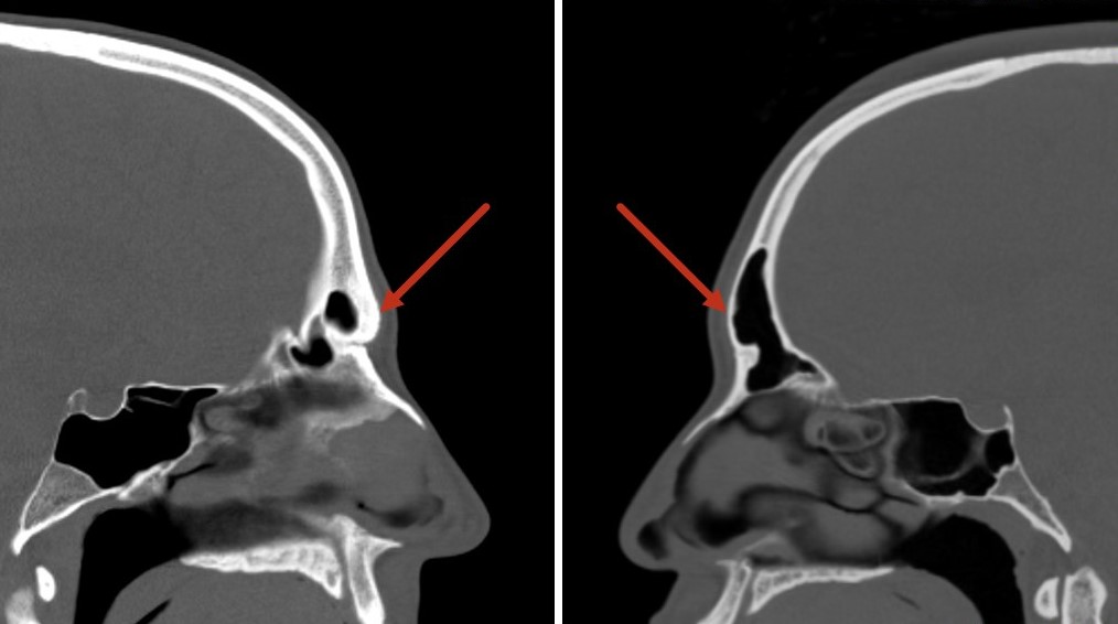 <p>Anterior Table Thickness of the Frontal Sinuses
