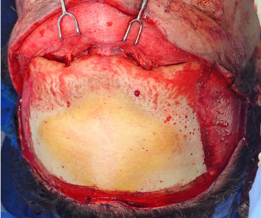 <p>Supraorbital Rim and Frontal Bone Exposure