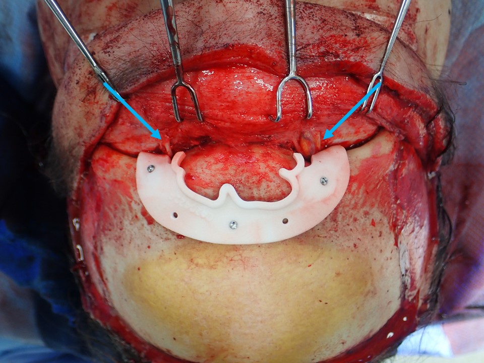 <p>Frontal Sinus Borders Identified Using a 3D-Printed Cutting Guide
