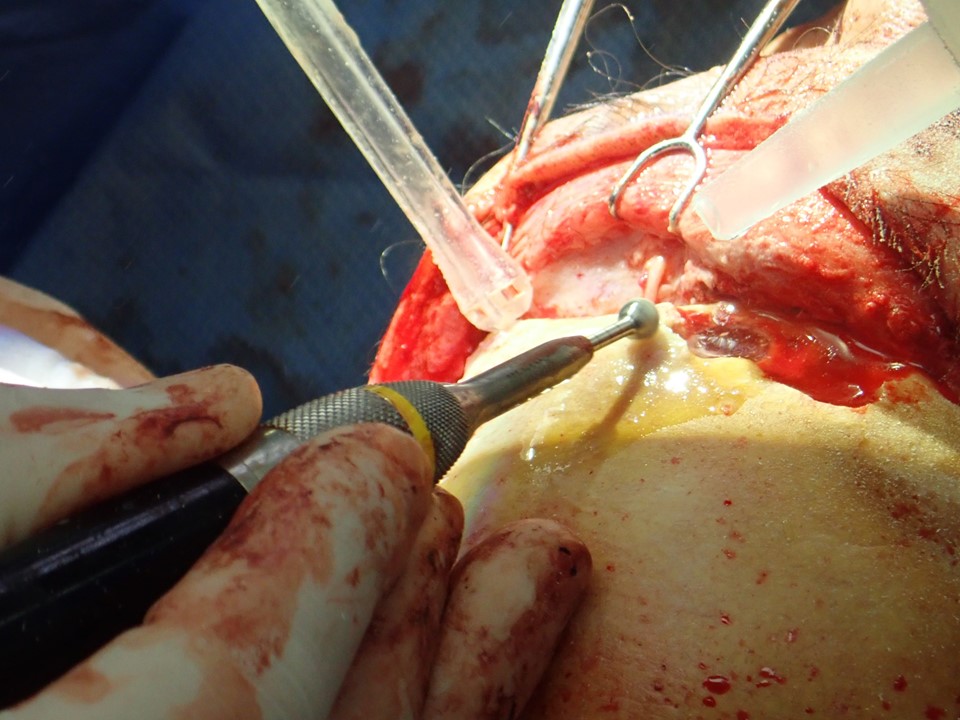 <p>Supraorbital Ridge Reduction