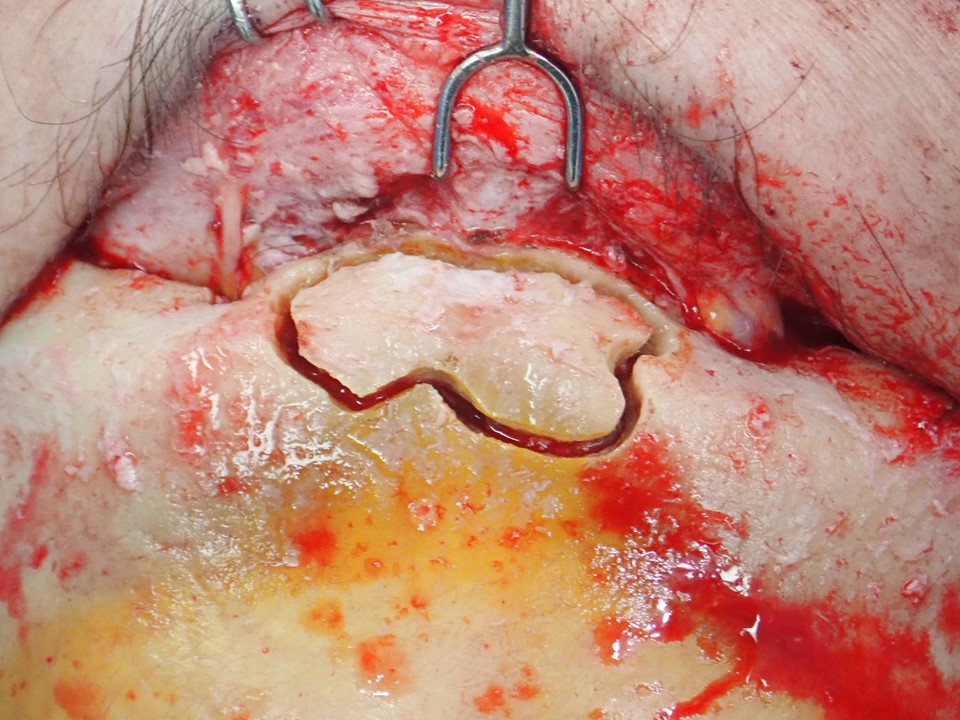 <p>Anterior Table of the Frontal Sinus Outlined for Removal