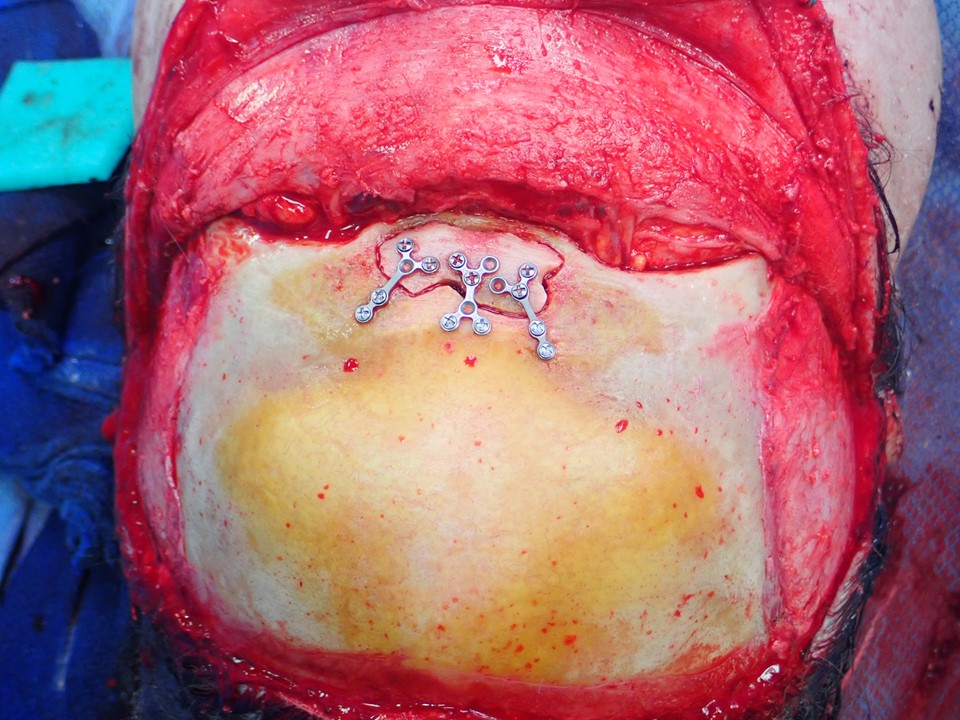 <p>Replacement and Fixation of the Anterior Table