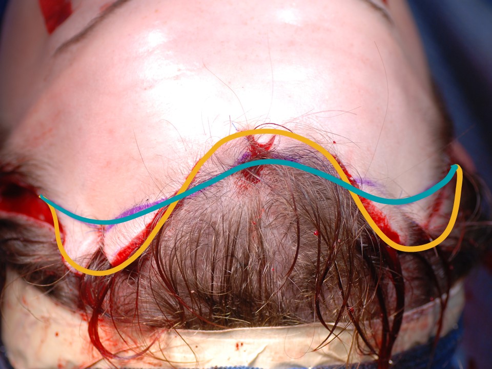 <p>Hairline Adjustment After Frontal Cranioplasty and Brow Lift