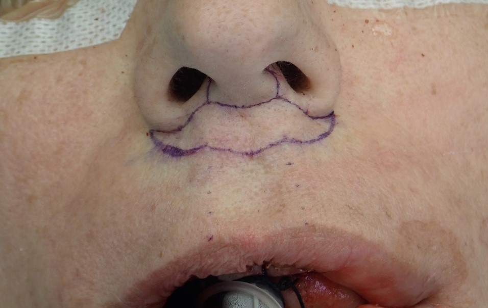 <p>Bullhorn Lip Lift Incision