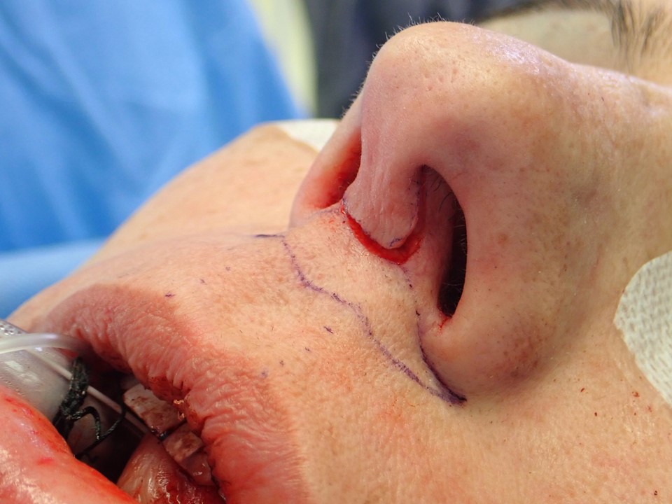 <p>Central Bullhorn Incision for Open Rhinoplasty