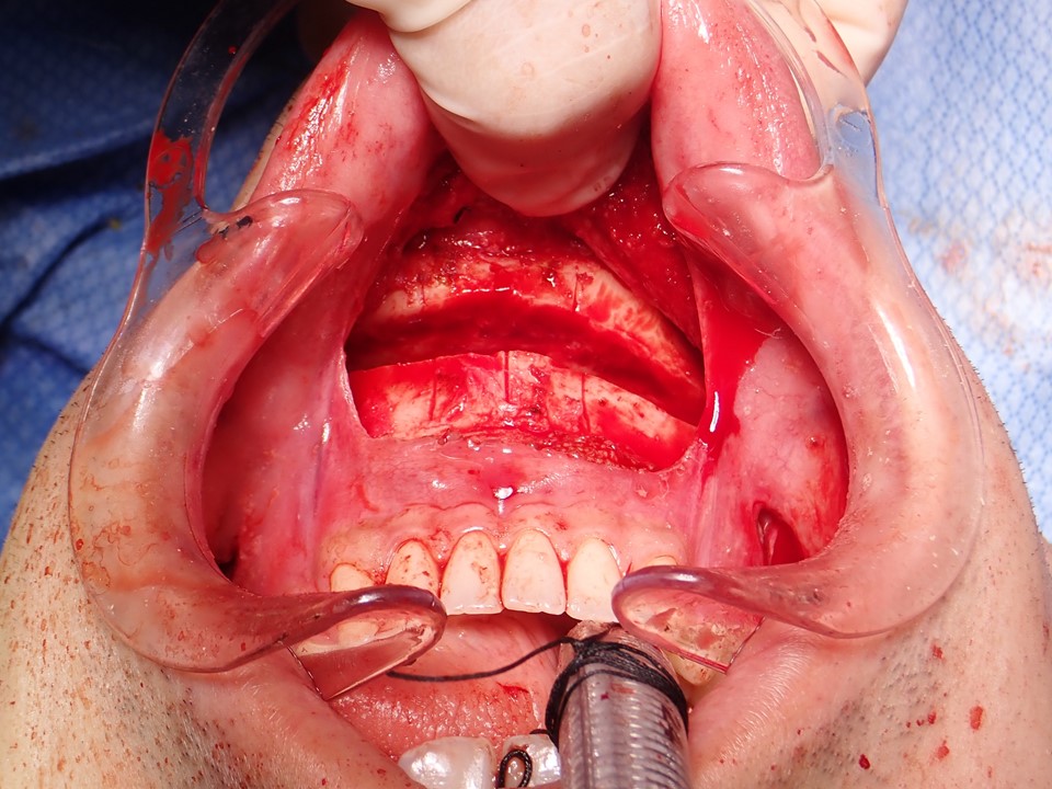 <p>Transverse Mandibular Osteotomy for Genioplasty