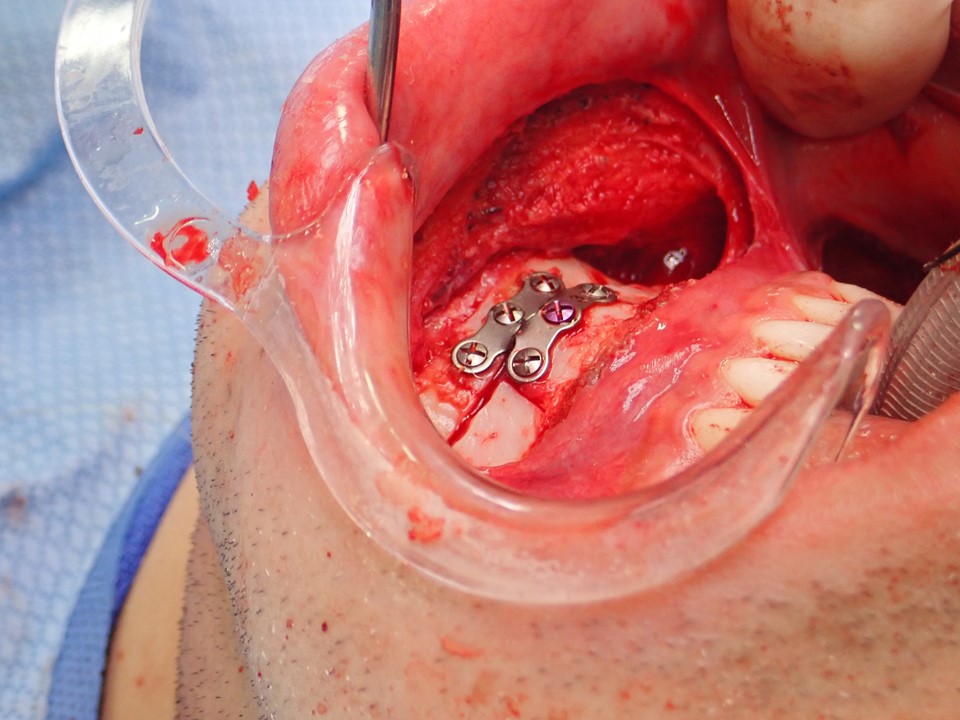 <p>Completed Genioplasty With Chin Retrusion