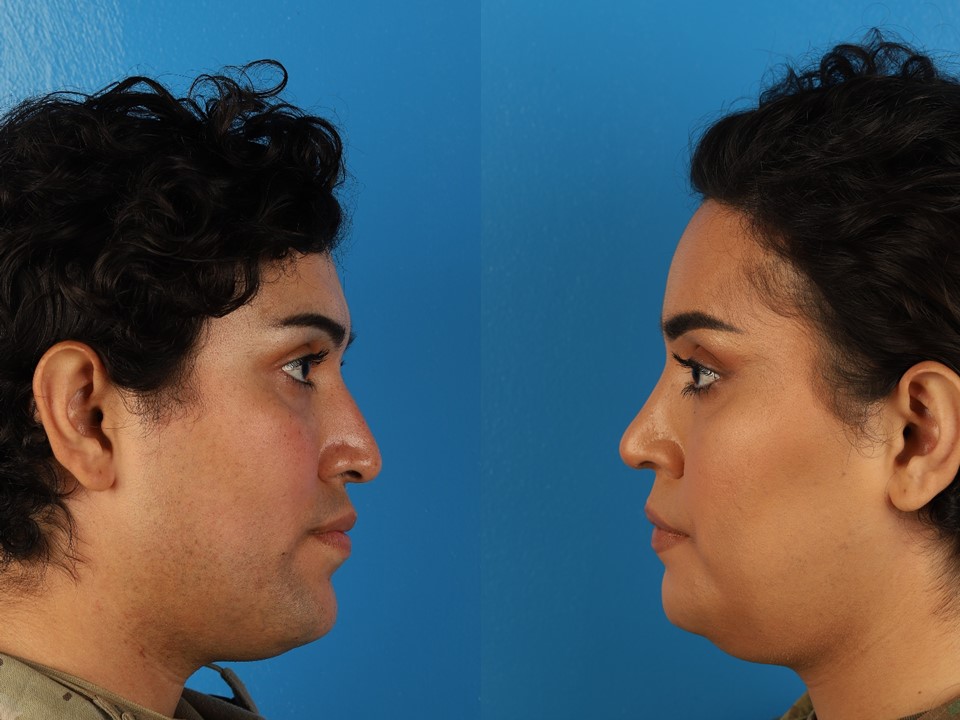 <p>Facial Feminization Surgical Procedures in a 27-Year-Old Transgender Woman