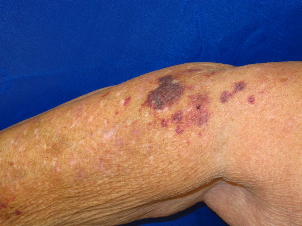 <p>Actinic Purpura