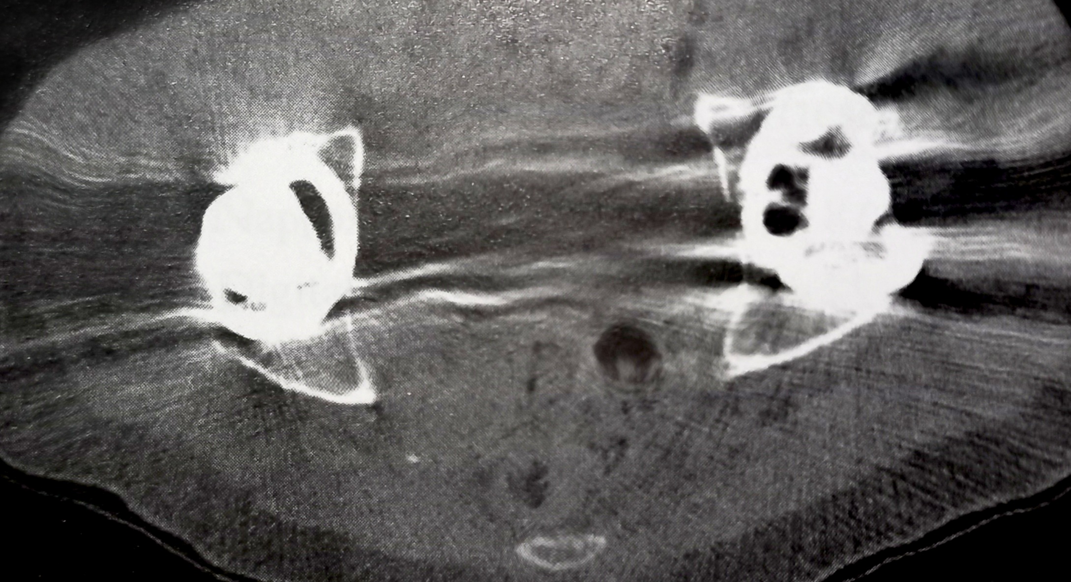<p>Metallic Artifacts on Pelvic Computed Tomography