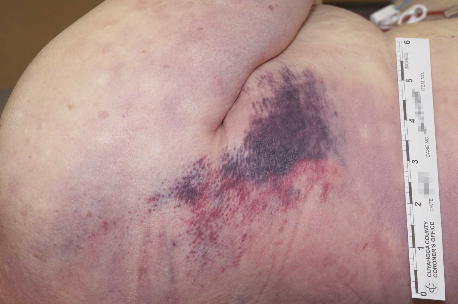 <p>Contusion of the Right Lateral Chest Beneath the Axilla.</p>