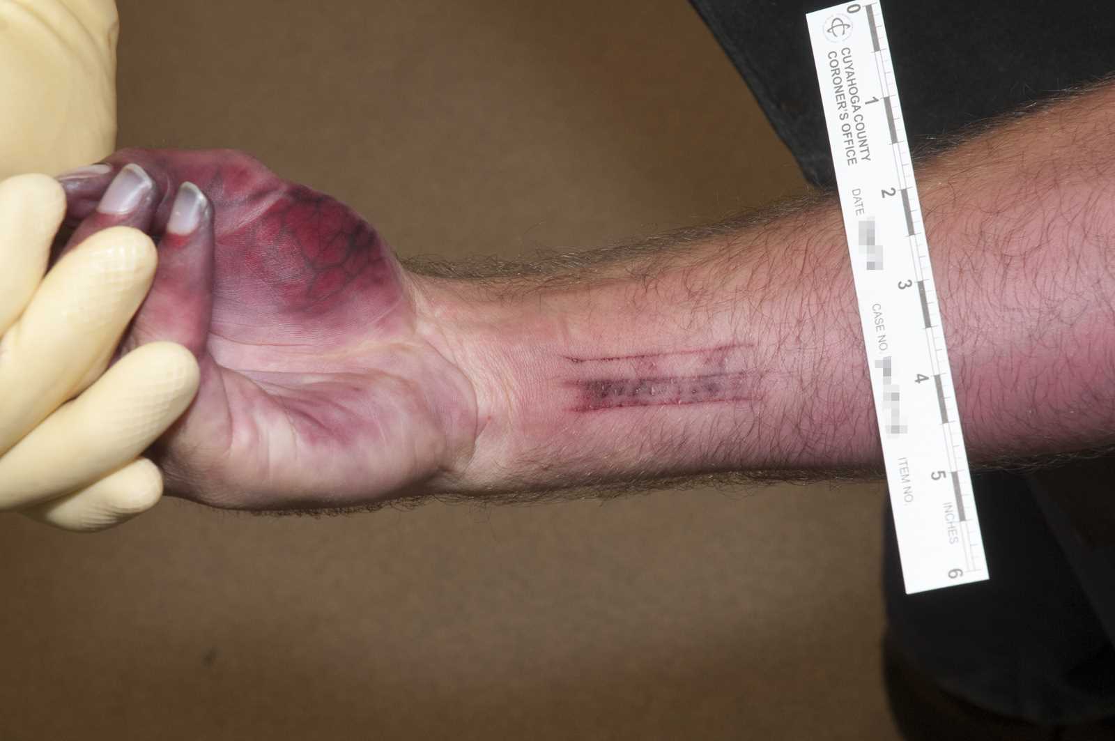 <p>Parallel, Linear Abrasions of the Ventral Aspects of the Right Wrist.</p>