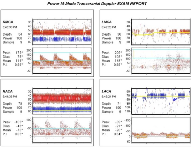 <p>Transcranial Doppler Ultrasound