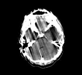 <p>Motion Artifact on Head Computed Tomography