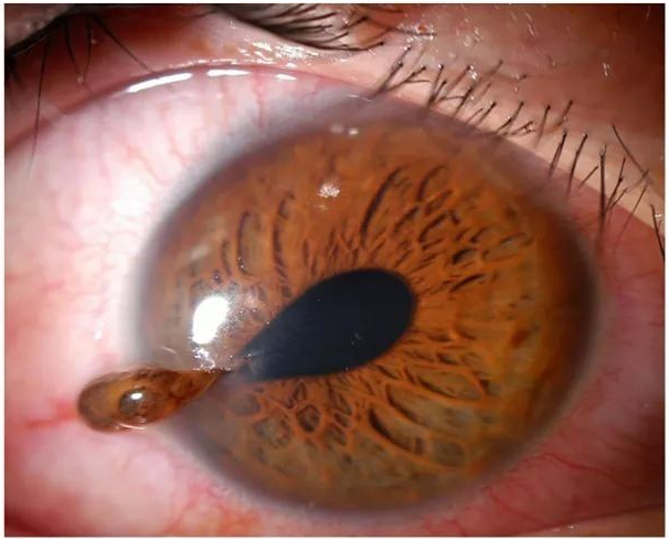<p>Teardrop Pupil with Vitreous Extrusion in Globe Rupture