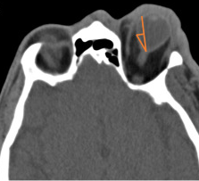 <p>Retrobulbar Hematoma&nbsp;and Proptosis on Computed Tomography