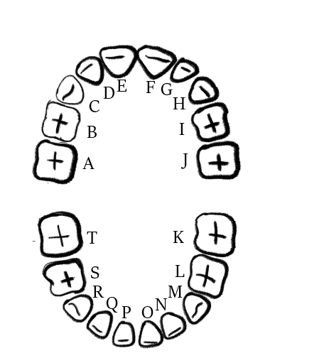 Primary dentition of a pediatric patient:
A: Right maxillary 2nd molar;
B: Right maxillary 1st molar;
C: Right maxillary c