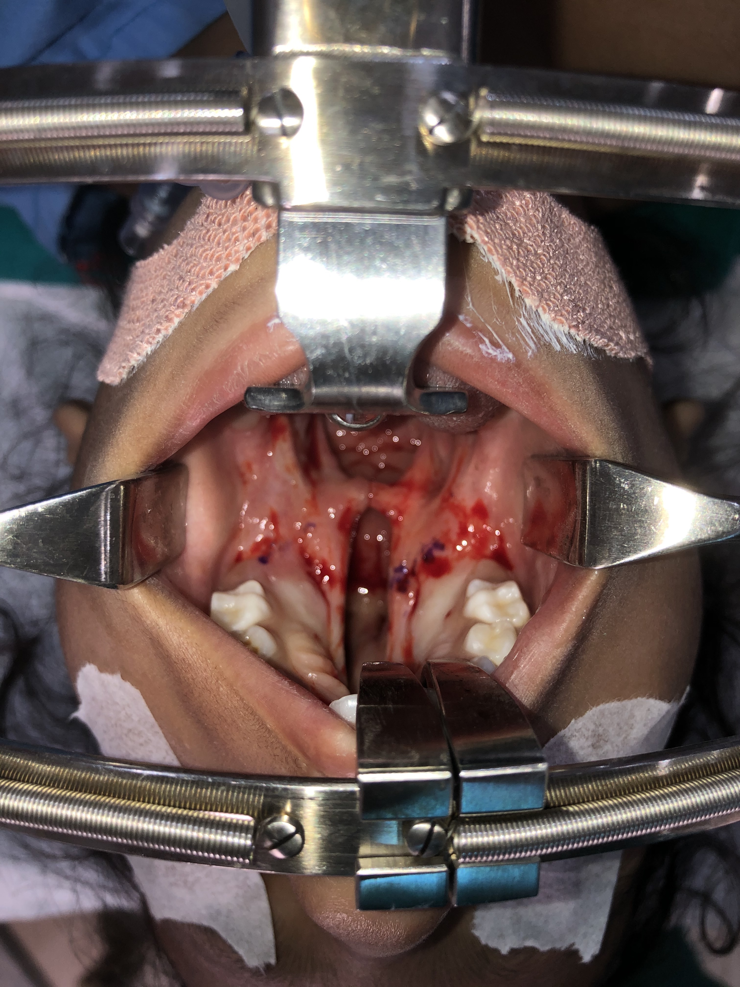 <p>Secondary Cleft Palate Involving Hard and Soft Palate