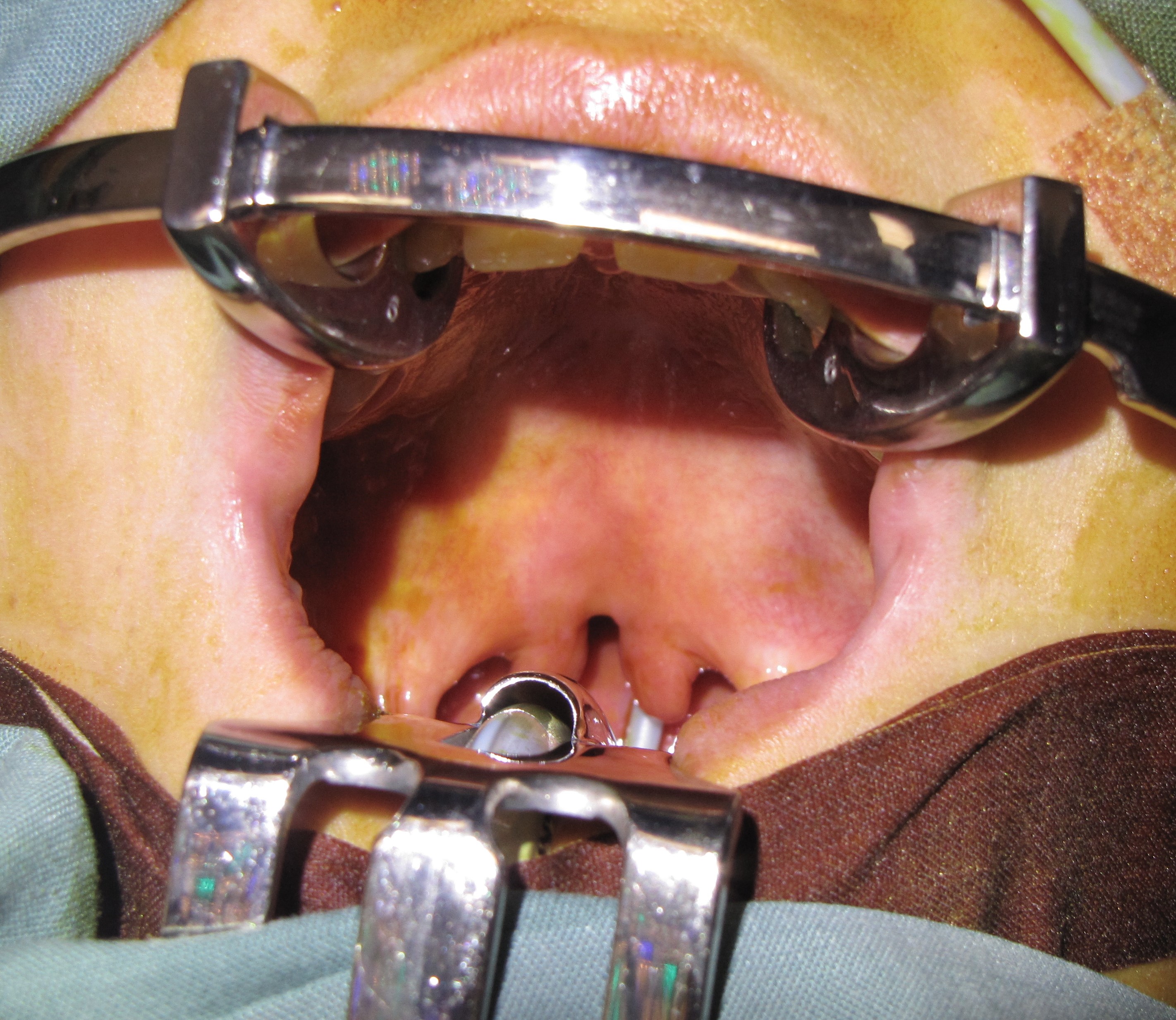 <p>Secondary Cleft Palate of Soft Palate Only