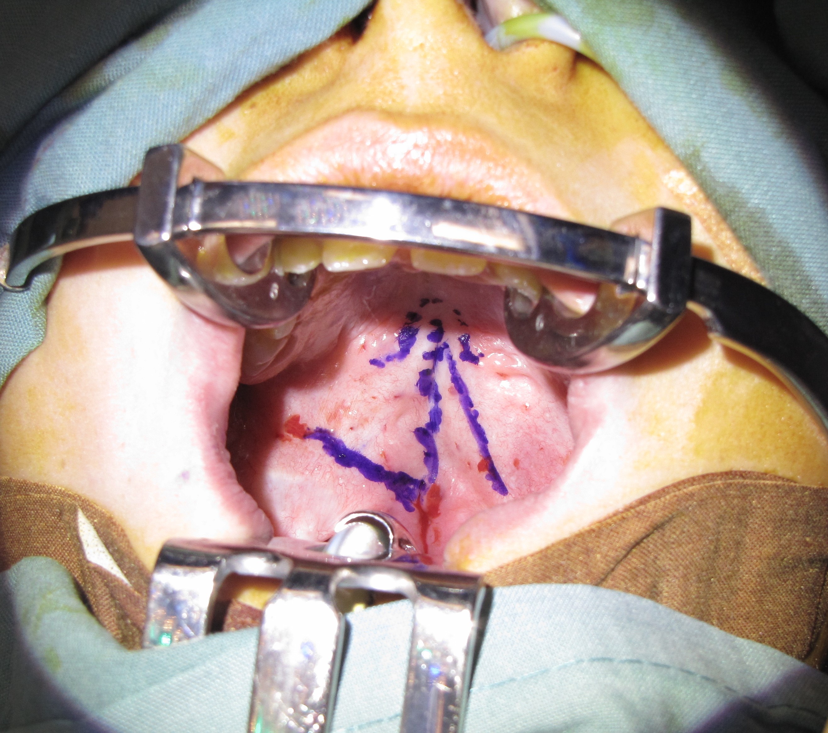 <p>Secondary Cleft Palate of Soft Palate
