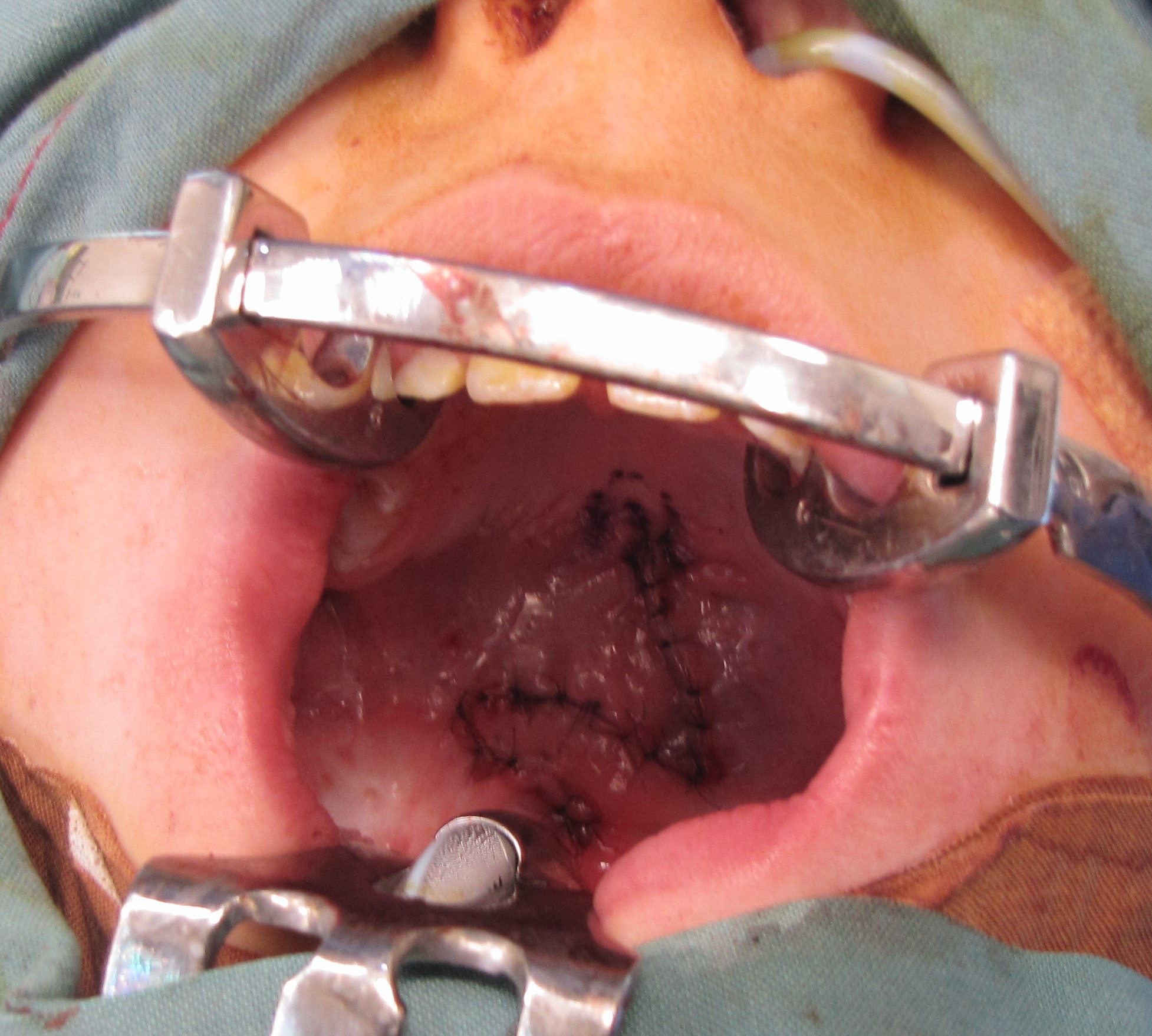 <p>Repaired Secondary Soft Palate