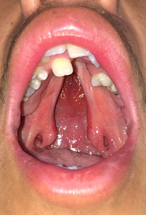 <p>Preoperative View of Isolated Cleft Palate