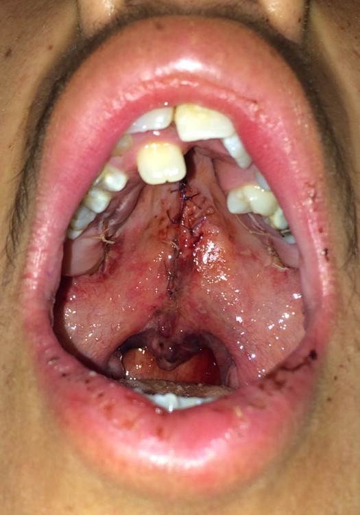 <p>Postoperative View of Isolated Cleft Palate