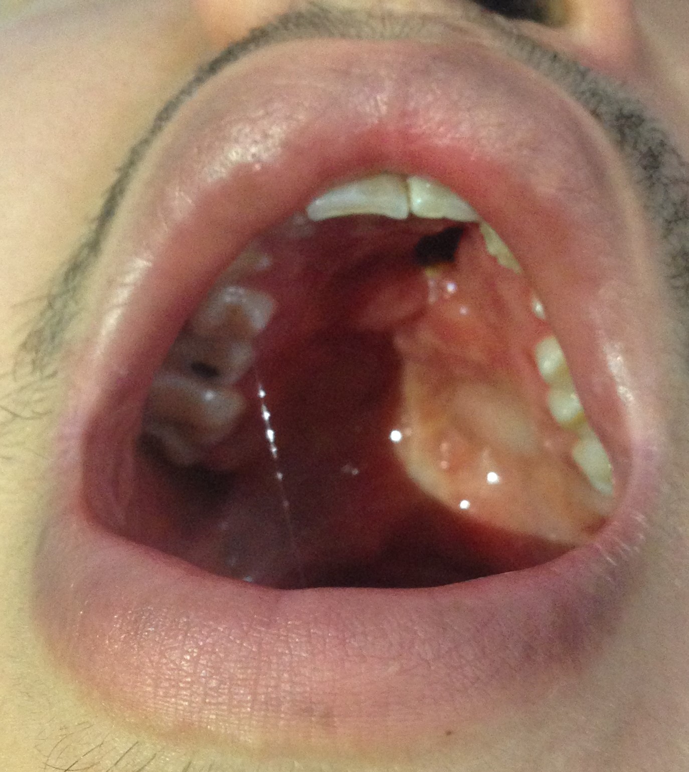 <p>Anterior Fistula of the Hard Palate After Repair