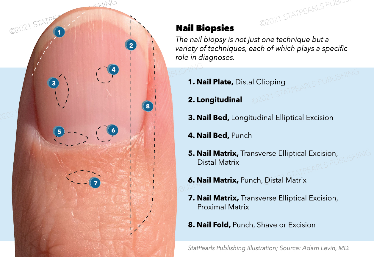 <p>Nail biopsy, nail plate, longitudinal, nail bed, nail matrix, nail fold, punch, shave, excision, transverse elliptical exc