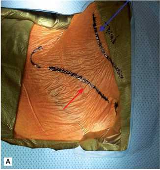 <p>Preoperative Markings for Carotid Endarterectomy