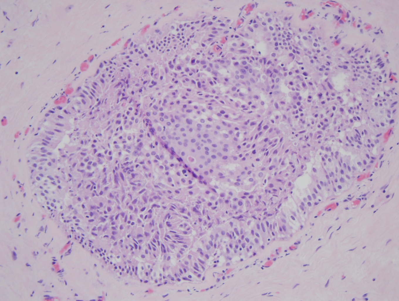 <p>Atypical Ductal Hyperplasia