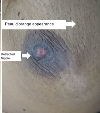 <p>Peau D'Orange. Peau d'orange appearance of the breast.</p>
