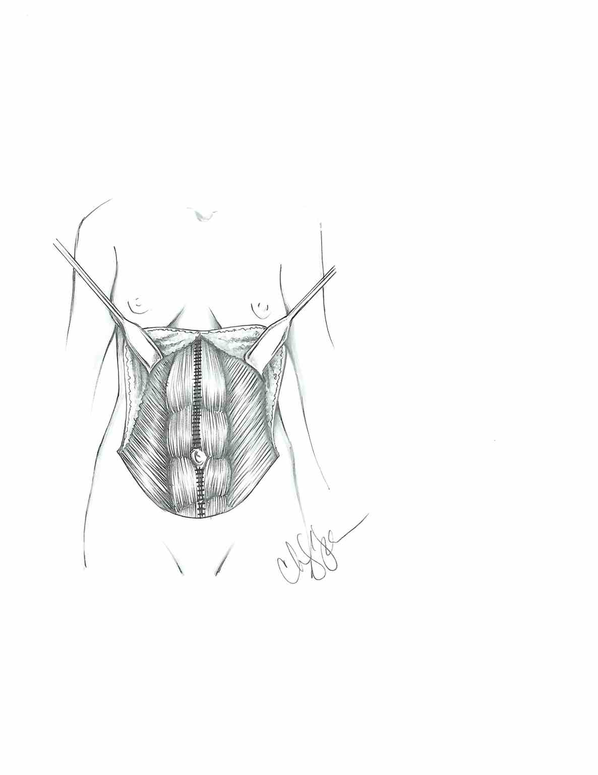 <p>Abdominoplasty After Plication of the Rectus Muscle.</p>