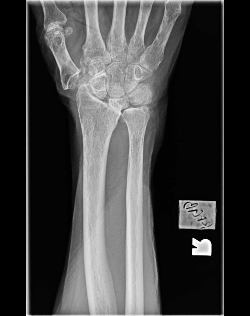 <p>Wrist Radiograph,&nbsp;Scapholunate Advanced Collapse (SLAC) Madelung Deformity.</p>