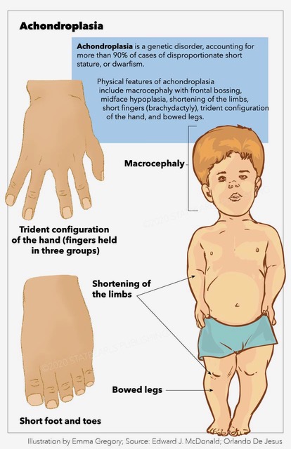 <p>Achondroplasia