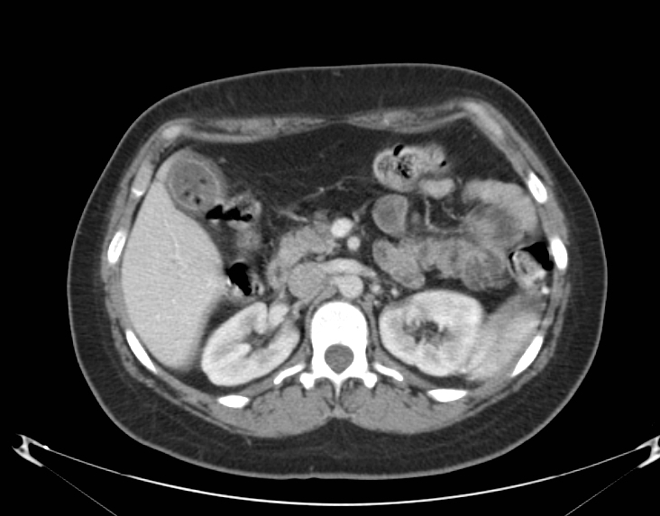 <p>Acute Cholecystitis, Abdomen CT.</p>