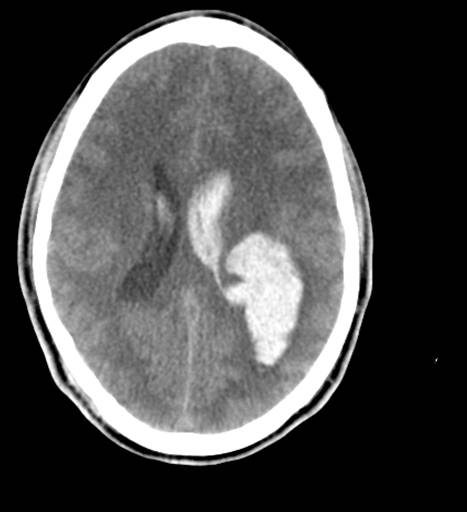 <p>Intraventricular and Intraparenchymal Hemorrhage From Arteriovenous Malformations (AVM), Head CT.</p>