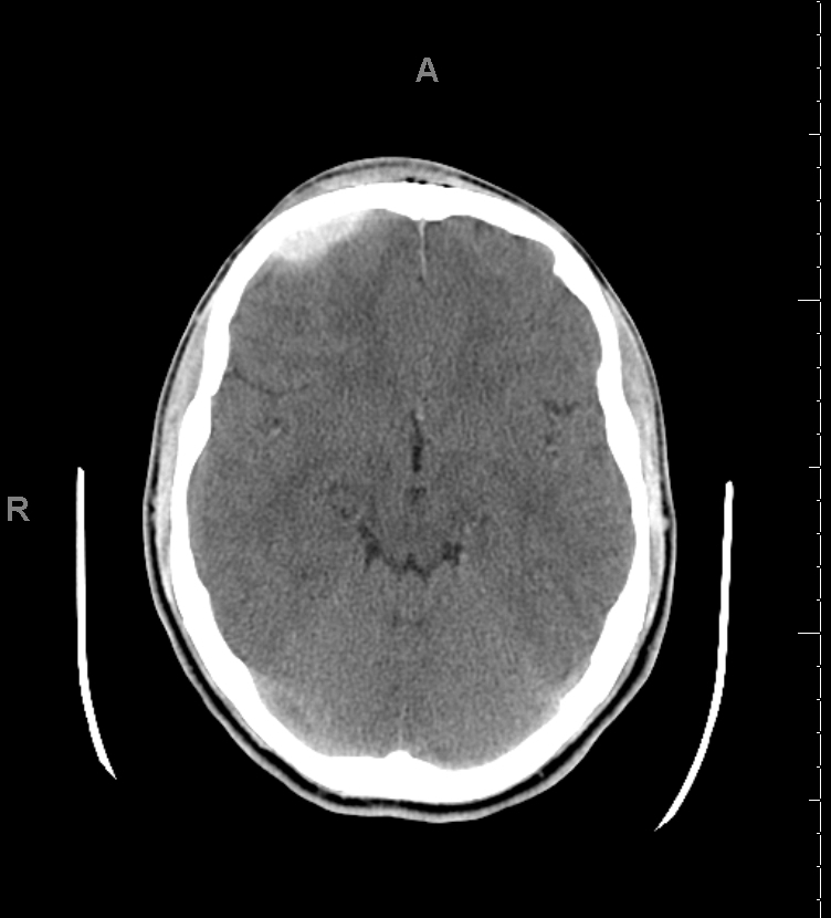 <p>Epidural Hematoma on Computed Tomography