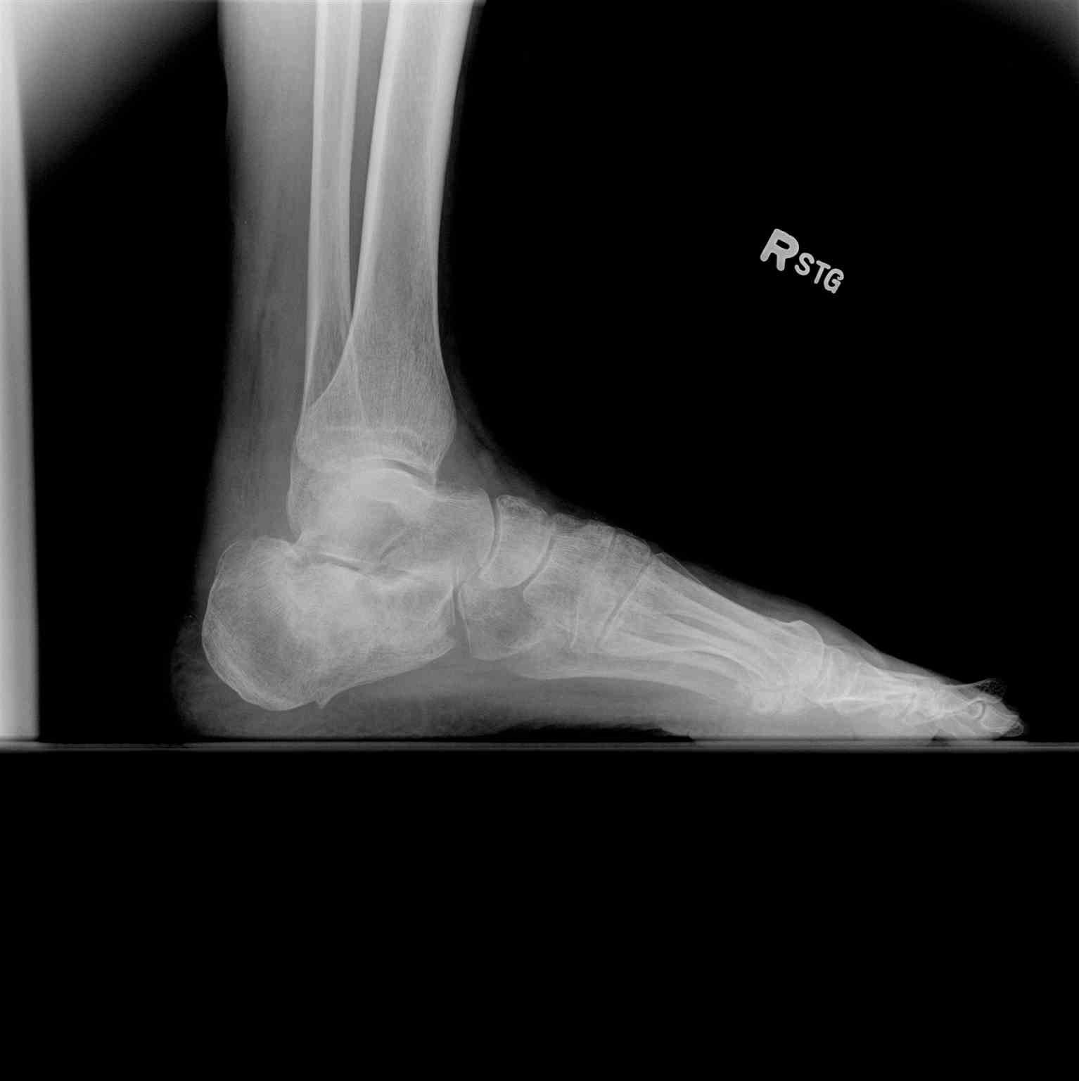 <p>Lateral Right Ankle Radiograph Exhibiting Calcaneal Fracture