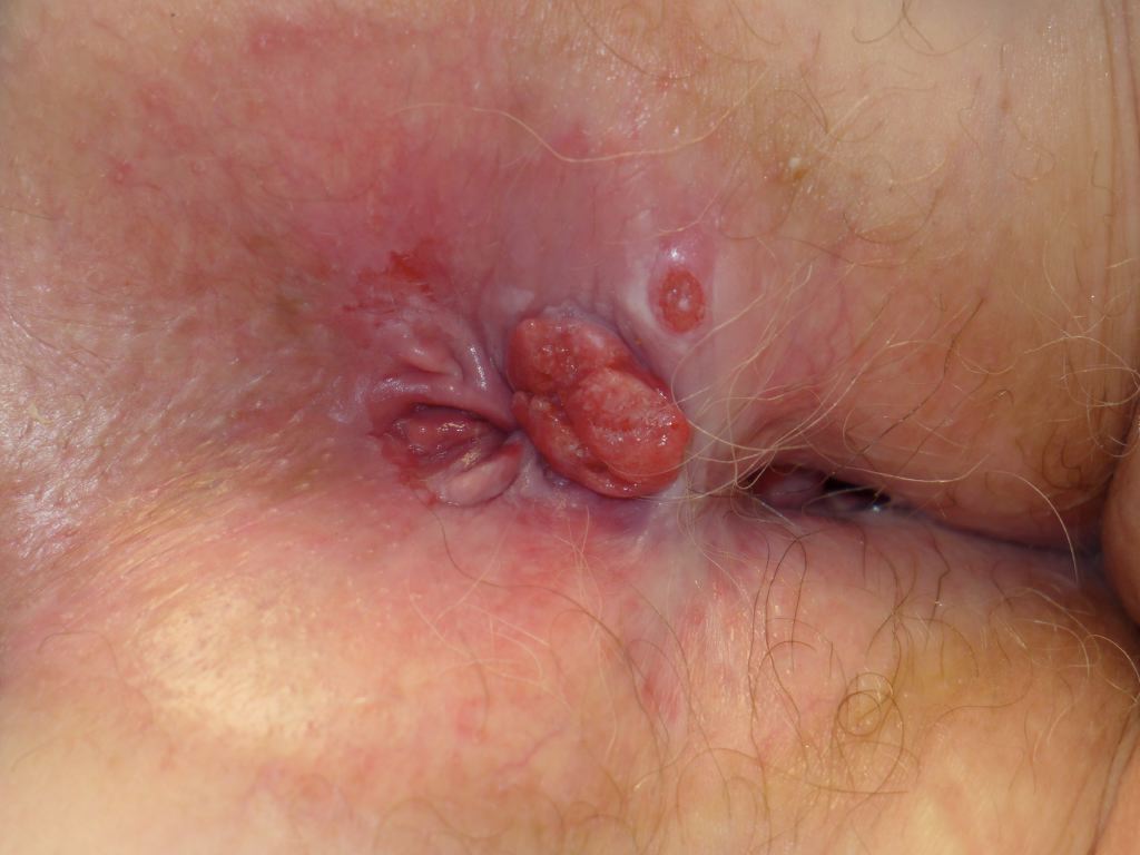 <p>Anal Carcinoma.</p>