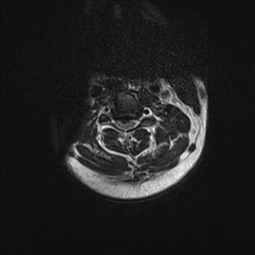<p>Cervical Spine, Magnetic Resonance Image. The image is an axial view of a herniated disk in the cervical spine.</p>