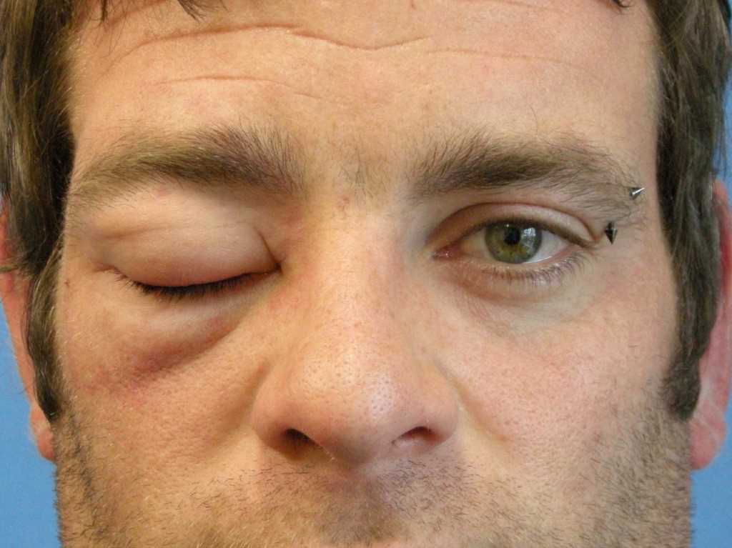 <p>Angioedema of the Periorbital Area