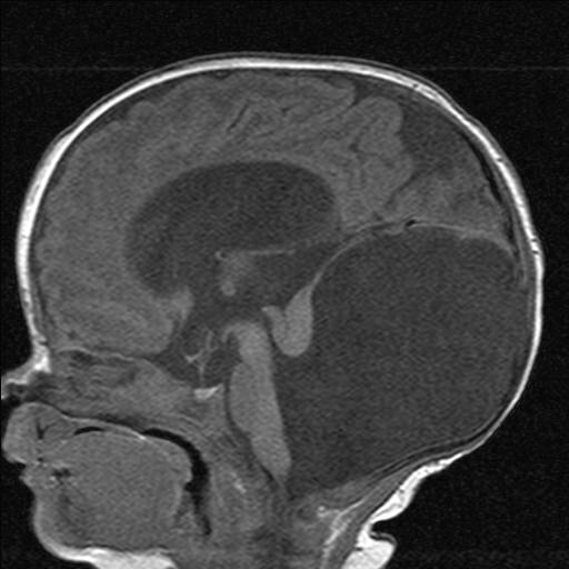 <p>MRI of a Child's Brain with Dandy-Walker Malformation.</p>