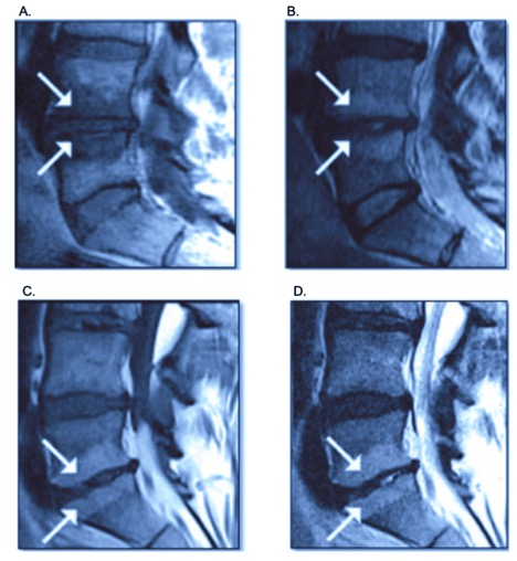 <p>Sagittal MRI of the Lumbar Spine Demonstrating Modic Type 1 and Type 2 Vertebral Endplate Changes