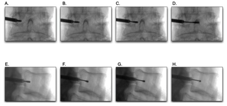 <p>Transpedicular Needle Positioning