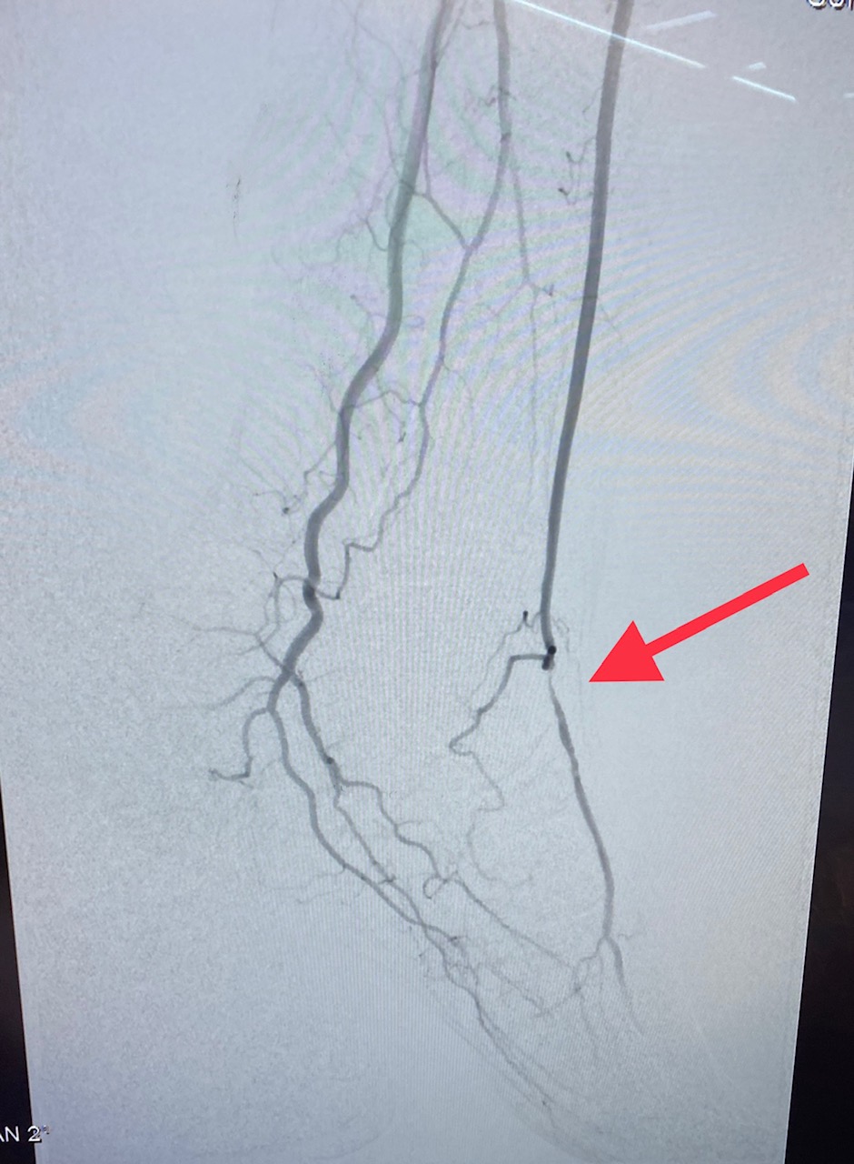 <p>Peripheral Arterial Disease. Image showing chronic total occlusion of the left superficial femoral artery.</p>