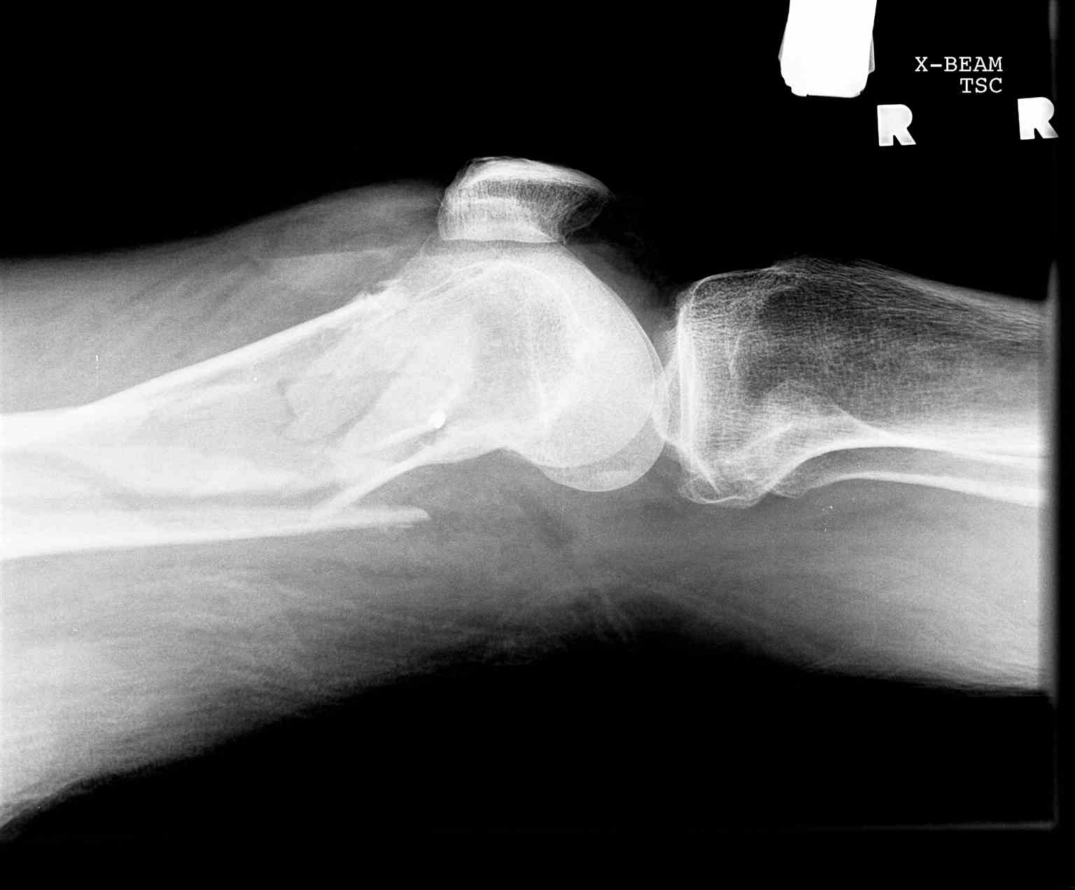 <p>Lateral Knee Fracture With Lipohemarthrosis, Radiograph