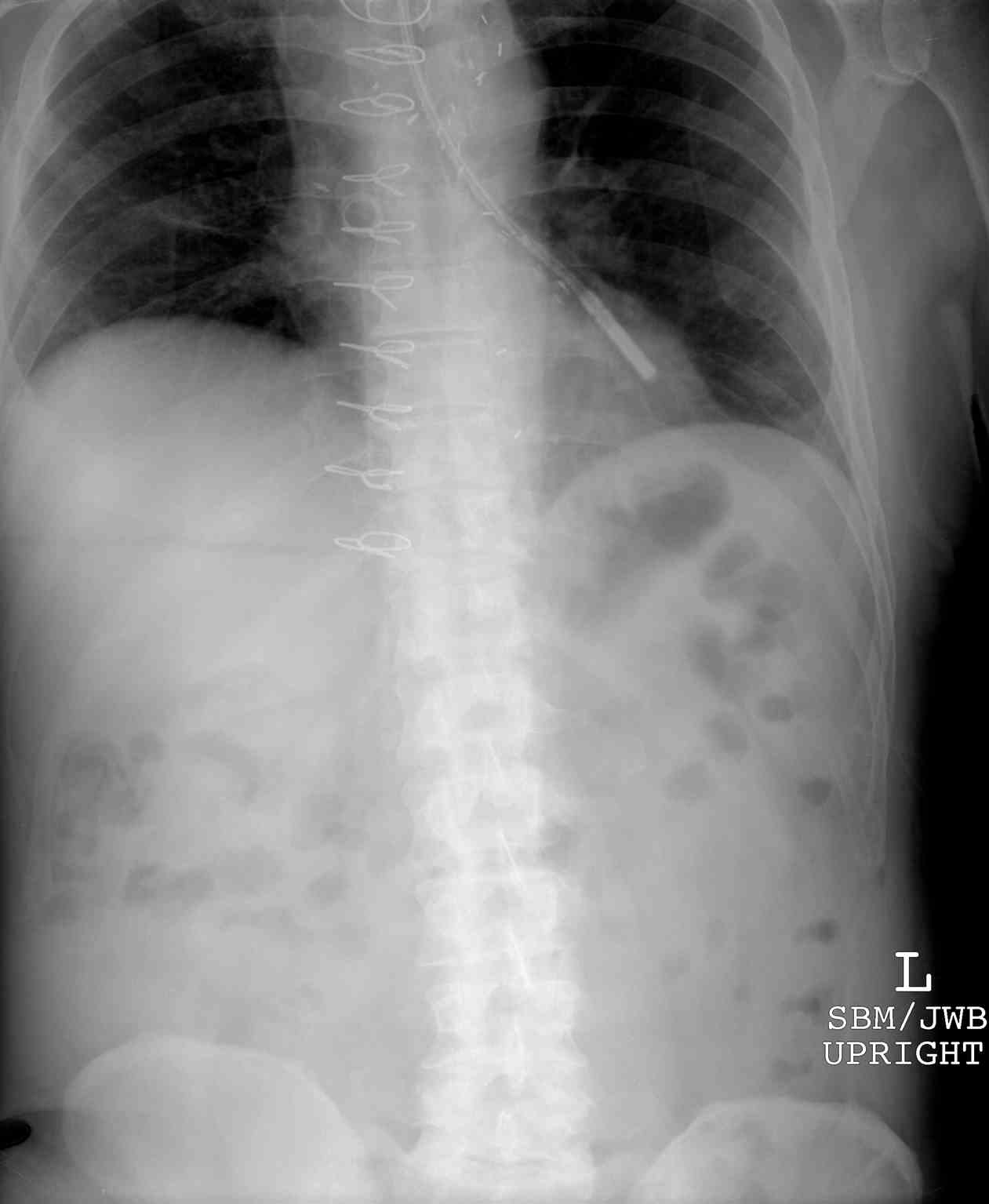 <p>Abdominal Radiograph, Feeding Tube in Left Mainstem Bronchus.</p>