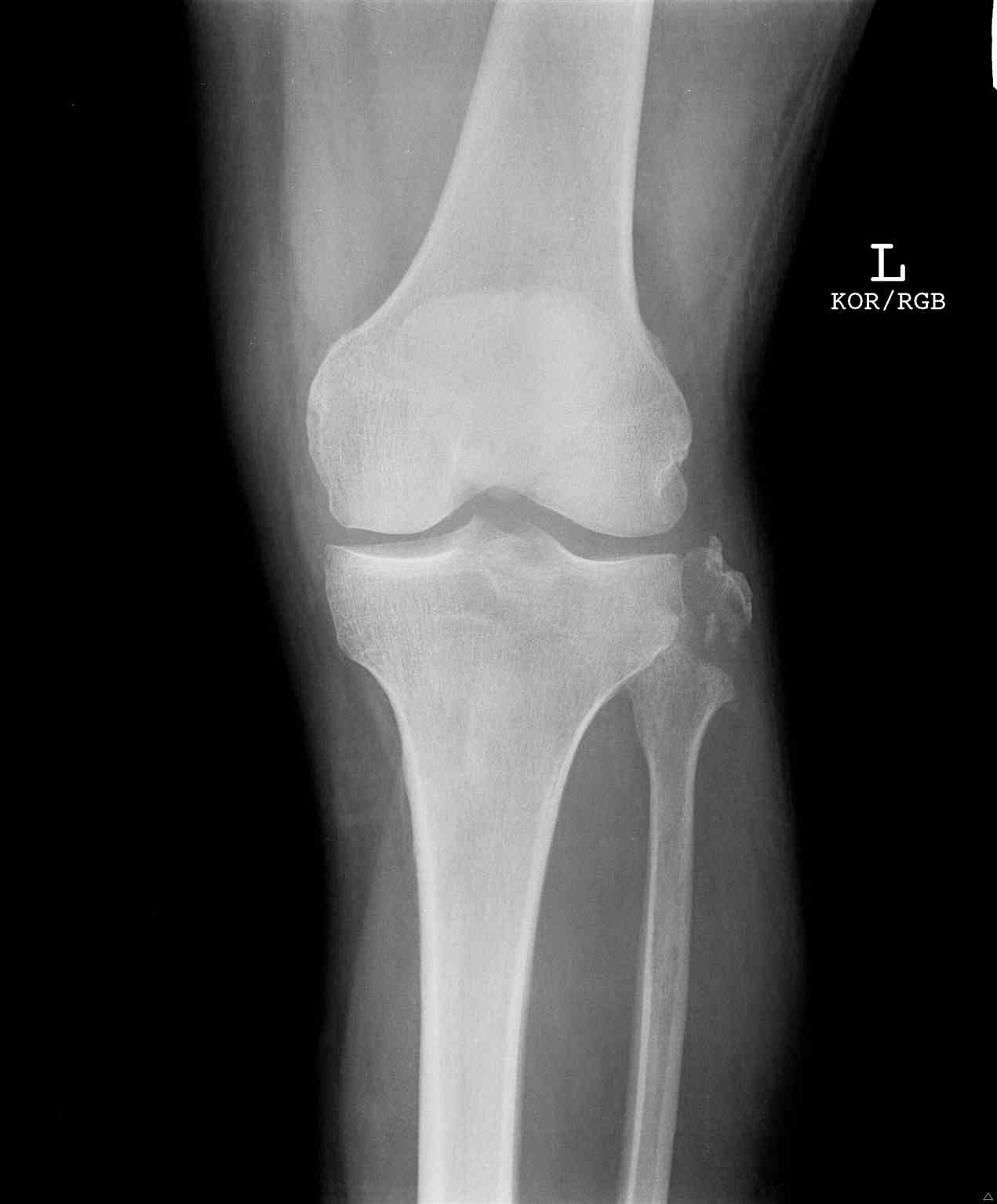 <p>Knee Radiograph, Fibular Avulsion Fracture.</p>